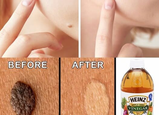 How to Get Rid of Skin Moles at Home Naturally. Must express something to keep getting my recipes.... Thank you😍 .Recipe in (c.o.m.m.e.n.t ).